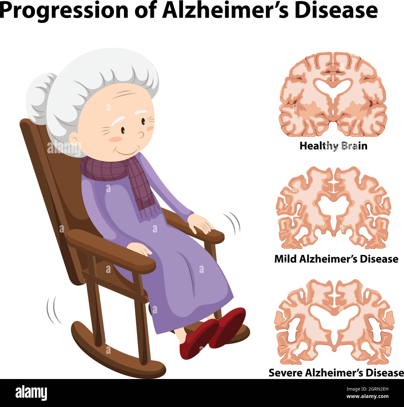 Progression of alzheimer's disease Stock Vector