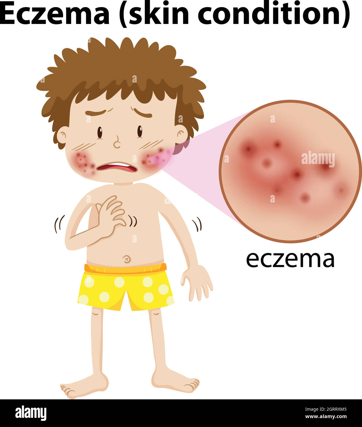A Young Boy Having Eczema Stock Vector Image & Art - Alamy