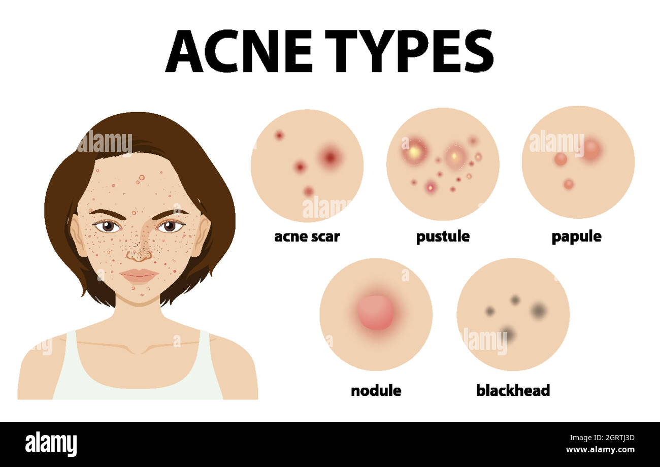 Types of acne on the skin or pimples Stock Vector