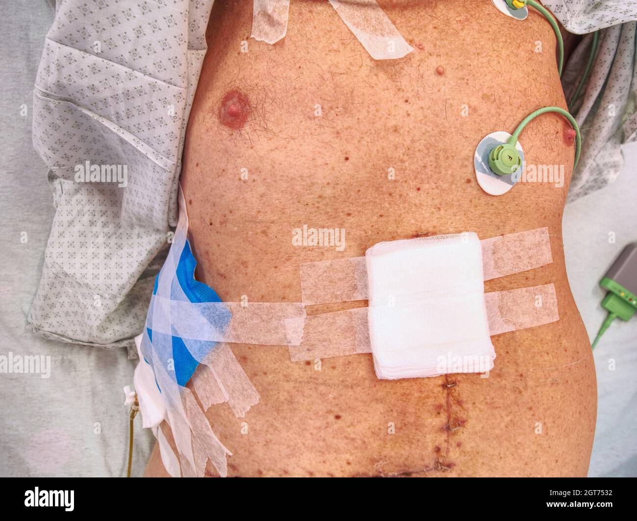 Surgical staple removal hires stock photography and images Alamy