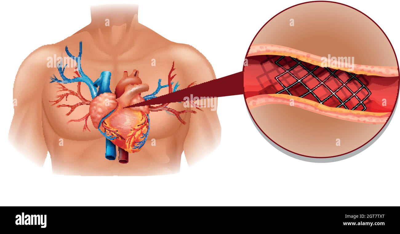 Heart disease diagram in human Stock Vector
