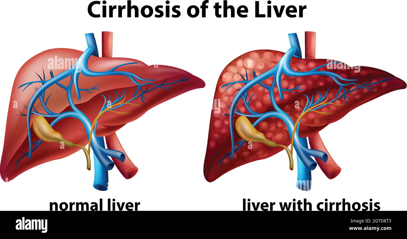 Cirrhosis of the liver poster Stock Vector Image & Art Alamy