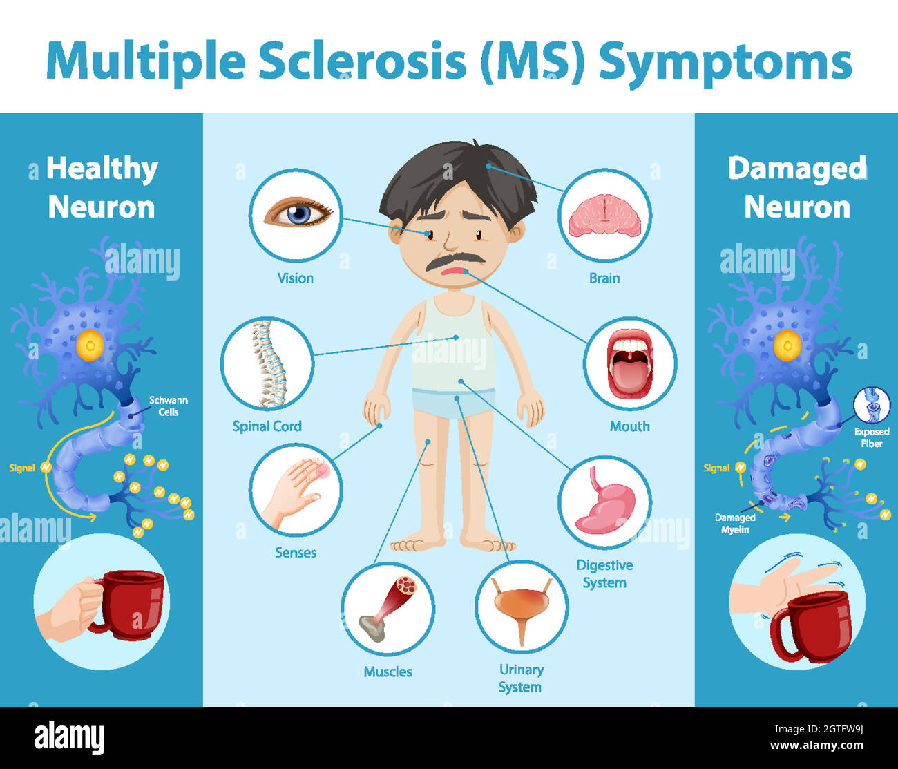 Symptoms multiple sclerosis Multiple sclerosis
