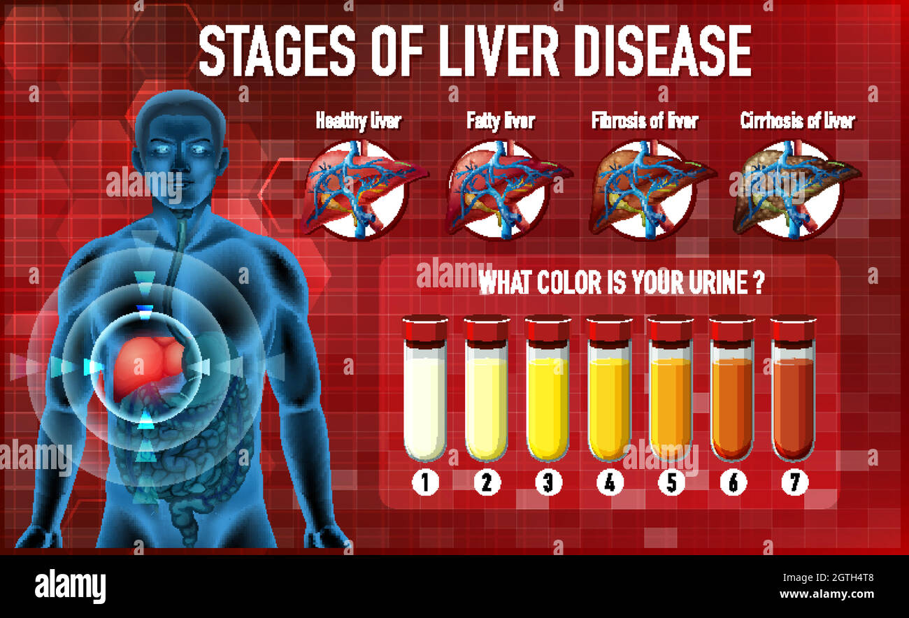 Stages of liver disease Stock Vector