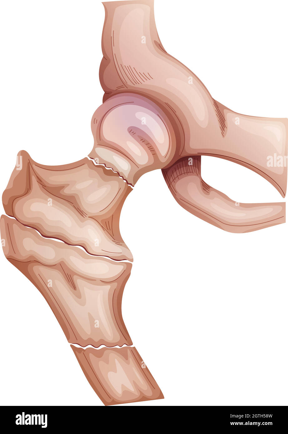 Hip fractures Stock Vector