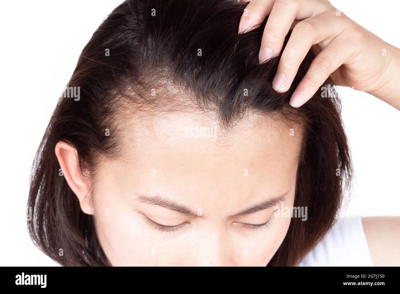 Close-up Of Woman Showing Receding Hairline Against White Background Stock Photo