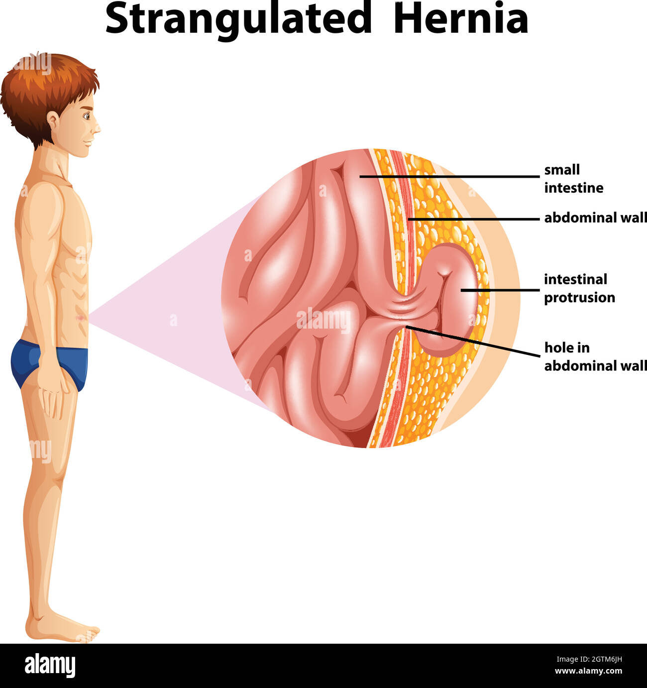 A Human Anatomy Strangulated Hernia Stock Vector