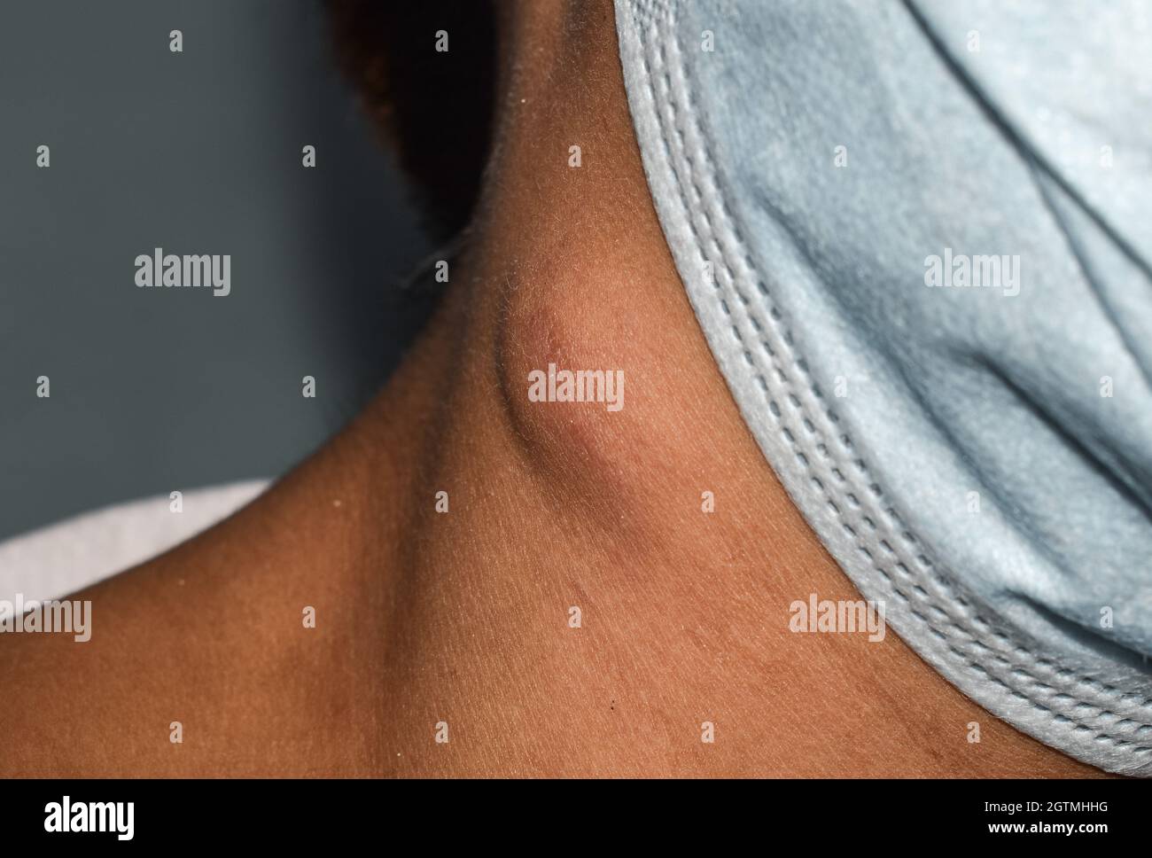 Single swelling or lymph node at the neck of Asian woman. Stock Photo