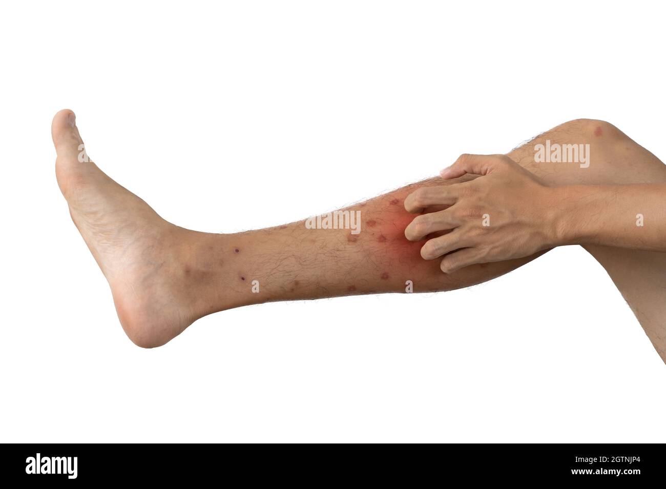 Scratching Leg High Resolution Stock Photography and Images Alamy