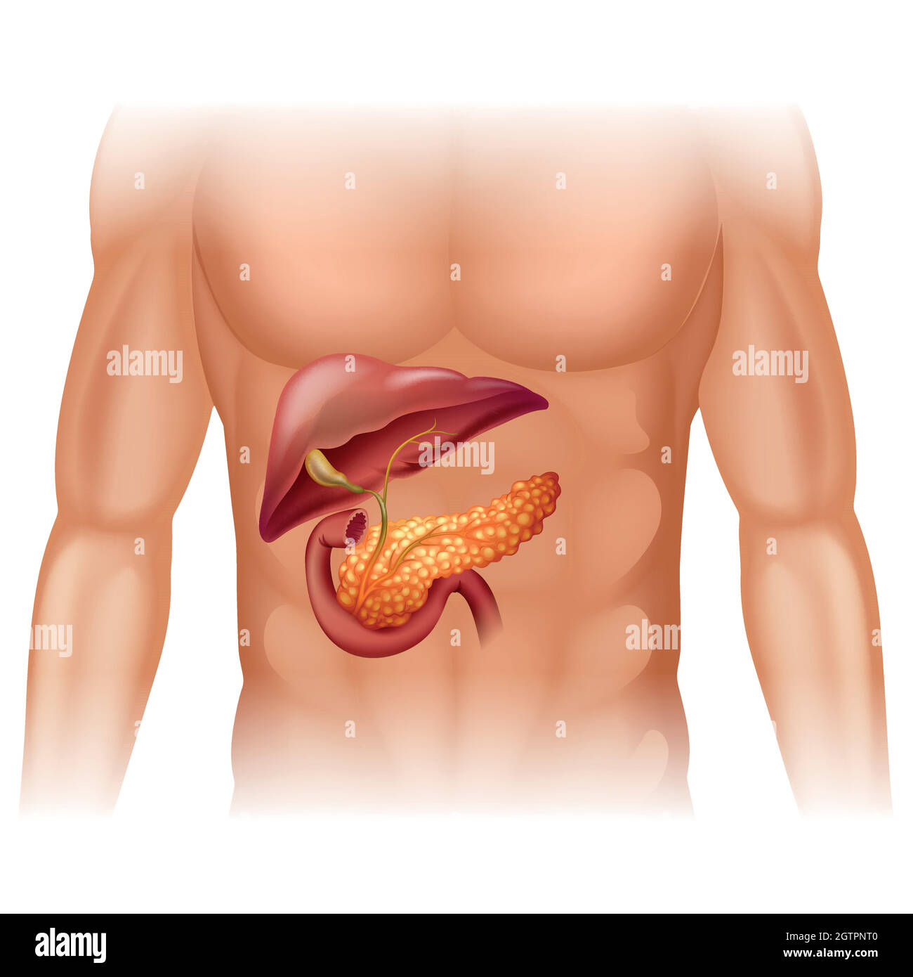 Pancreas cancer diagram in detail Stock Vector