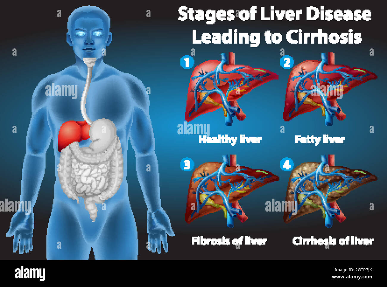 Stages of liver disease Stock Vector