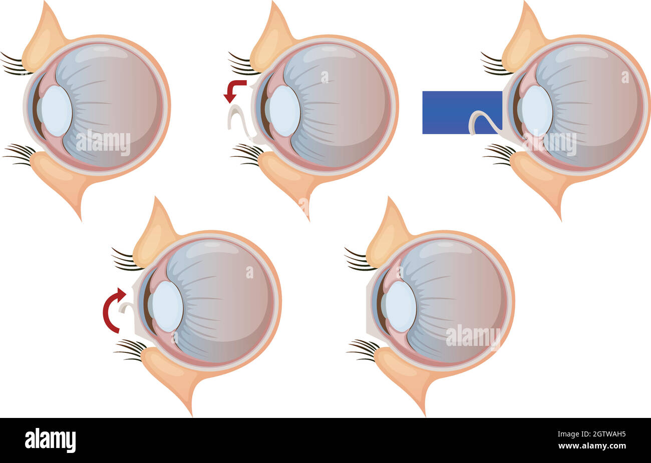 Laser eye correction Stock Vector