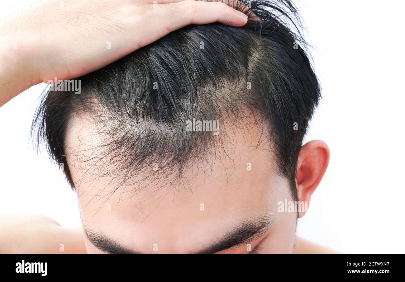 Close-up Of Man With Receding Hairline Against White Background Stock Photo