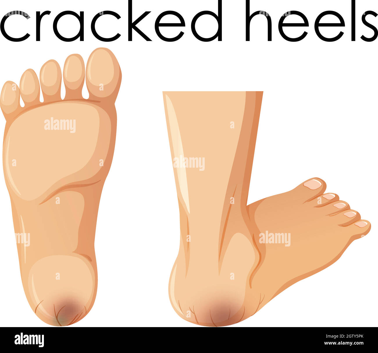 A Set of Human Foot with Cracked Heels Stock Vector