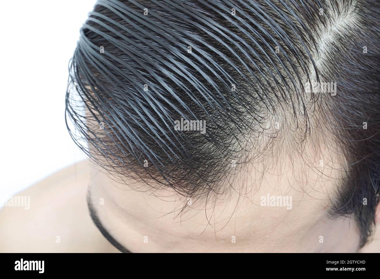 Close-up Of Man With Receding Hairline Against White Background Stock Photo