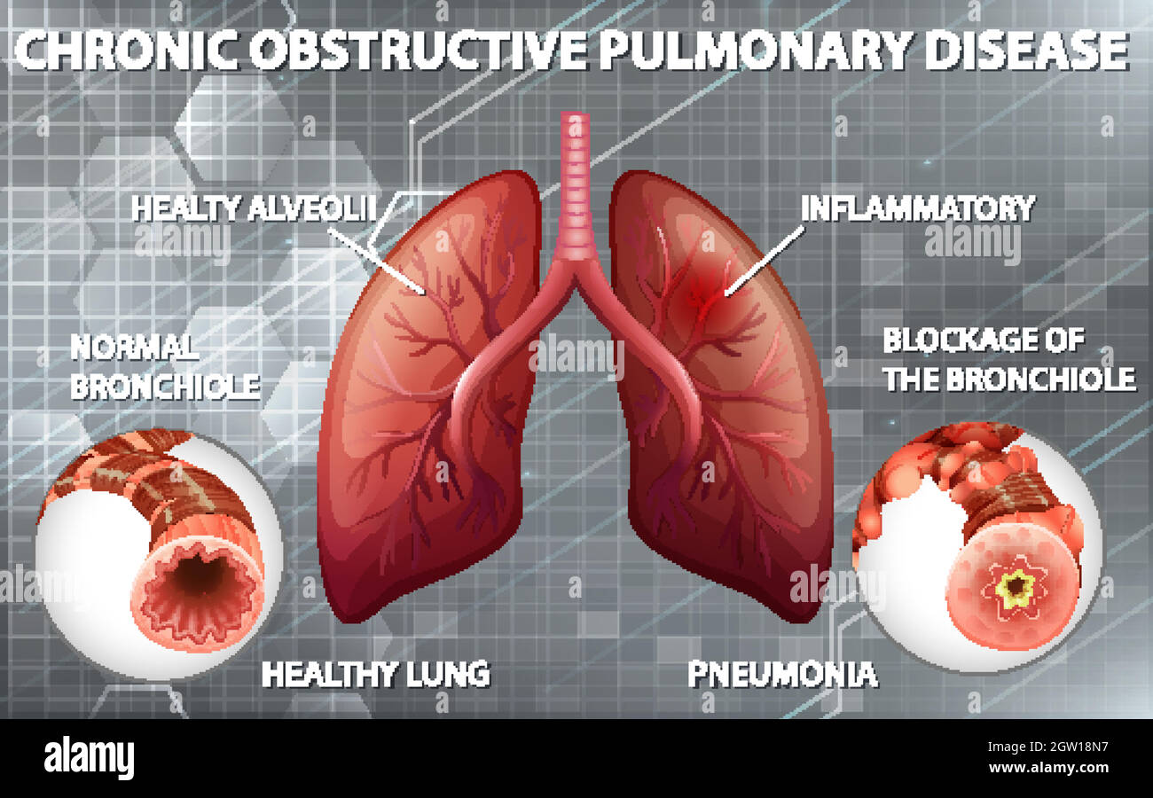 Pulmonary copd Stock Vector Images - Alamy