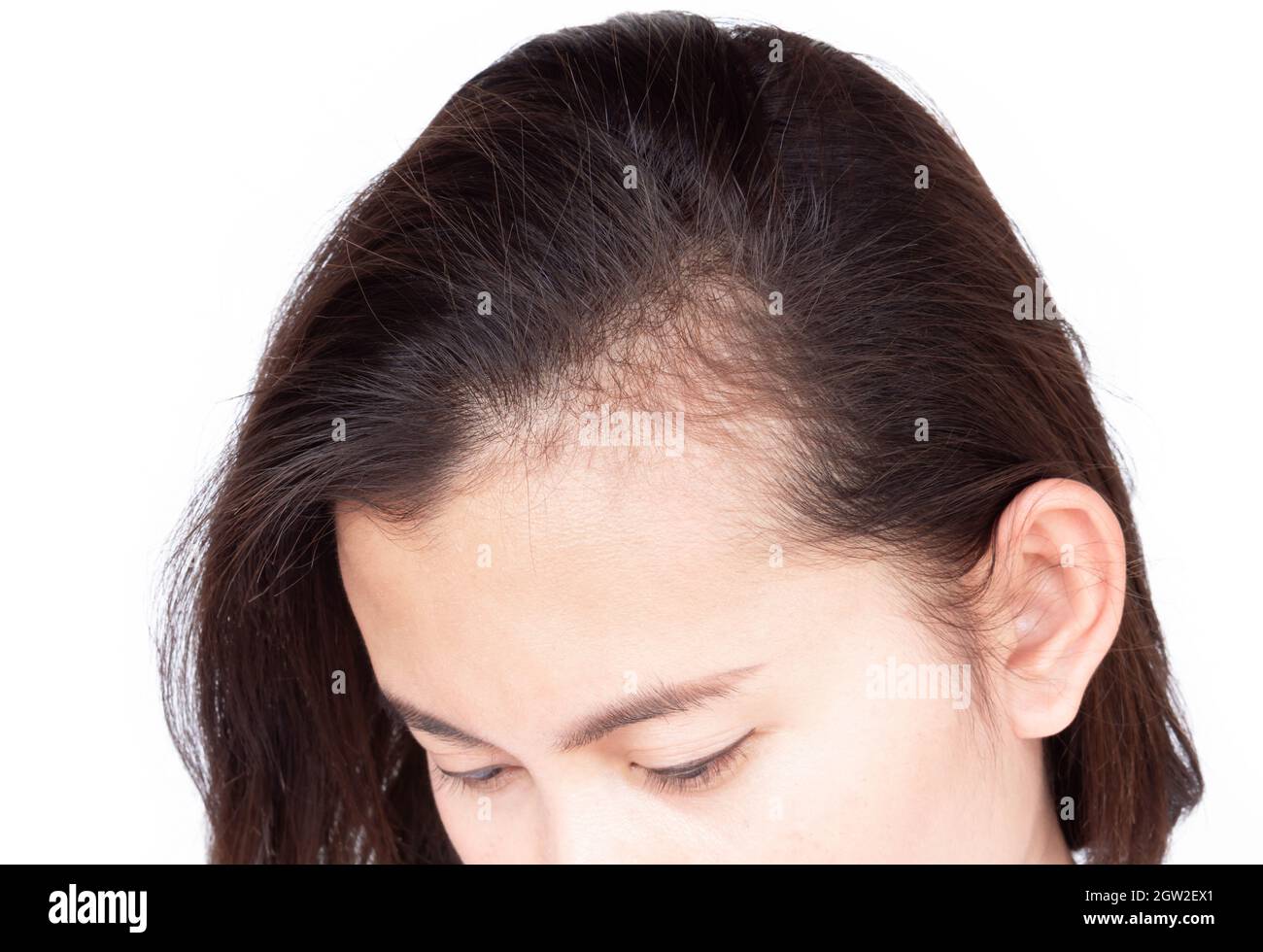 Close-up Of Woman With Receding Hairline Against White Background Stock Photo