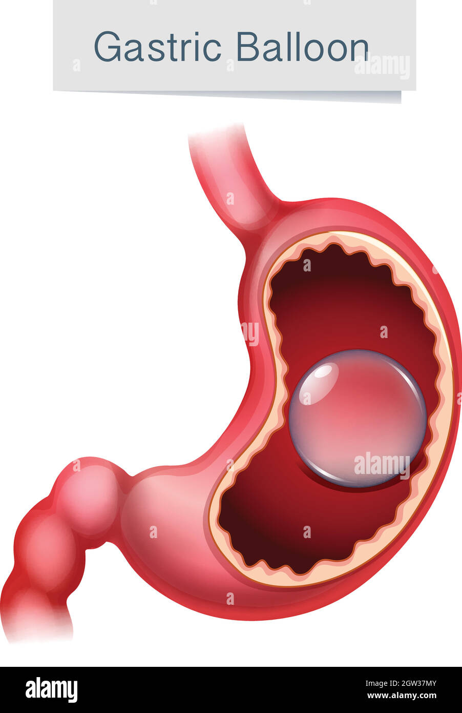 Human Anatomy Gastric Balloon Illustration Stock Vector
