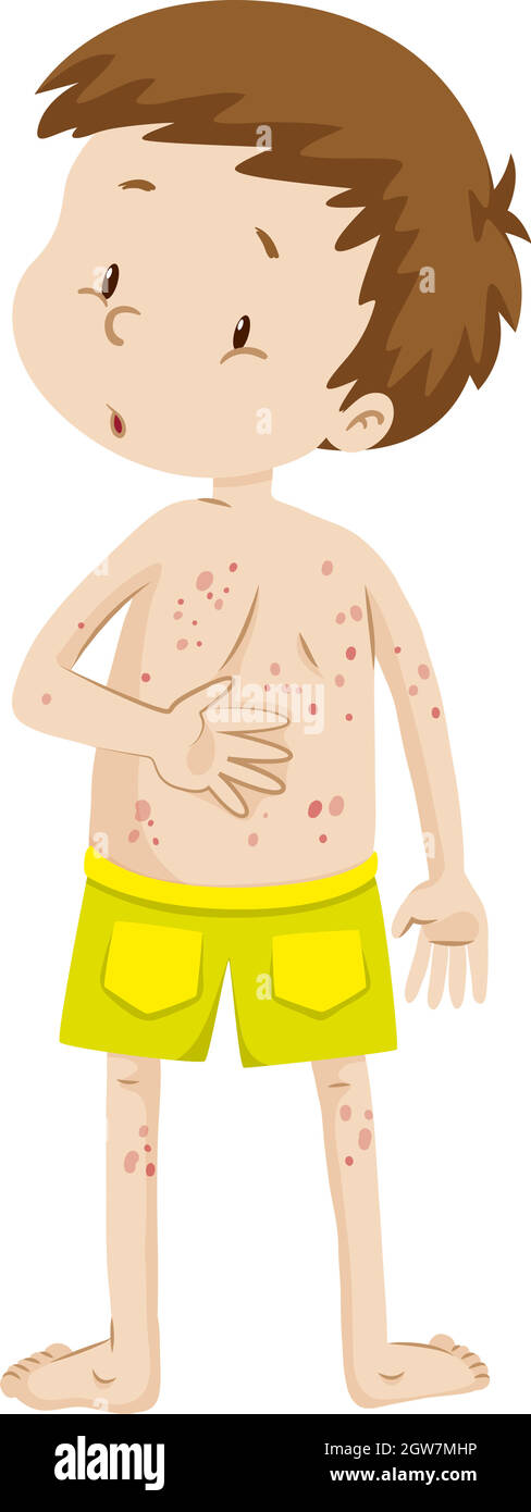 Little boy with rashes in his back Stock Vector