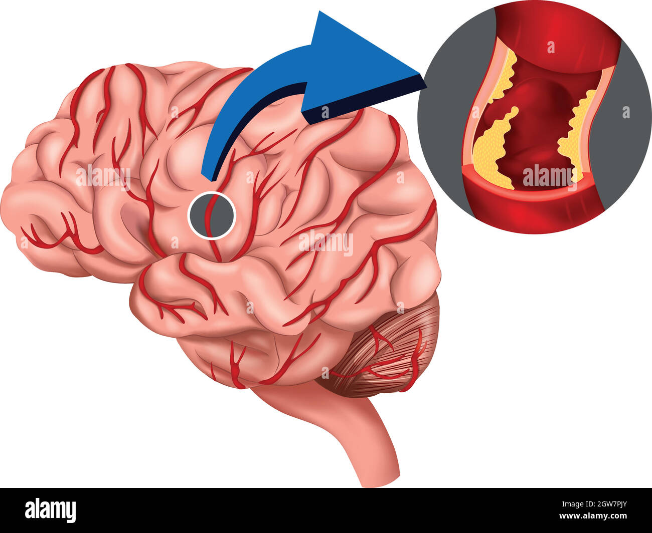 Blood Clot concept in the brain Stock Vector