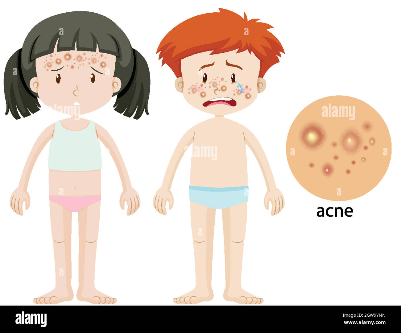 Boy and girl with acne problem Stock Vector