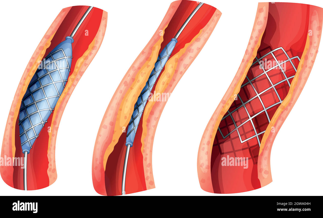 Stent used to open blocked artery Stock Vector Image & Art - Alamy
