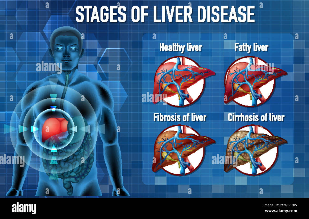 Stages of liver disease Stock Vector Image & Art Alamy