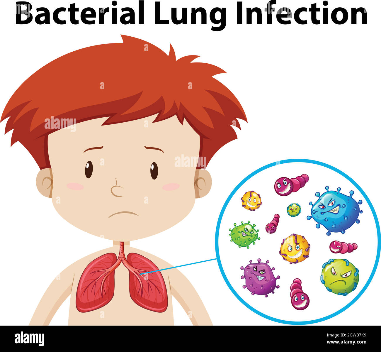 A Boy Bacterial Lung Infection Stock Vector Image & Art Alamy