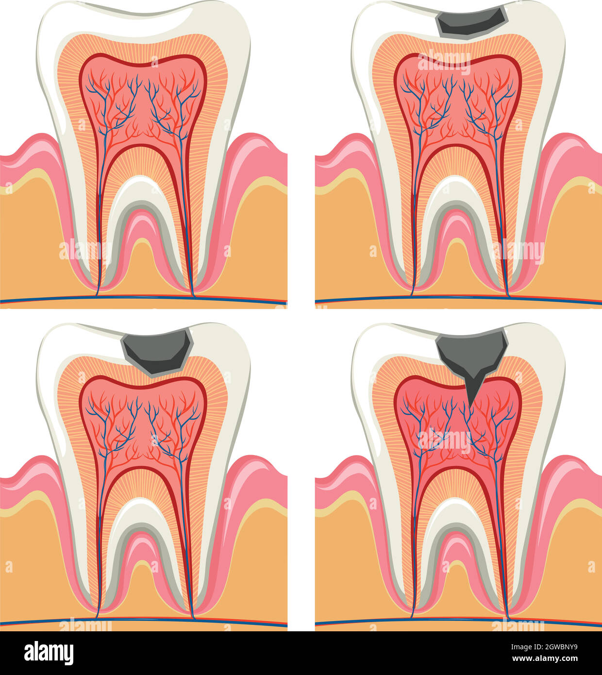 Tooth decay diagram in details Stock Vector