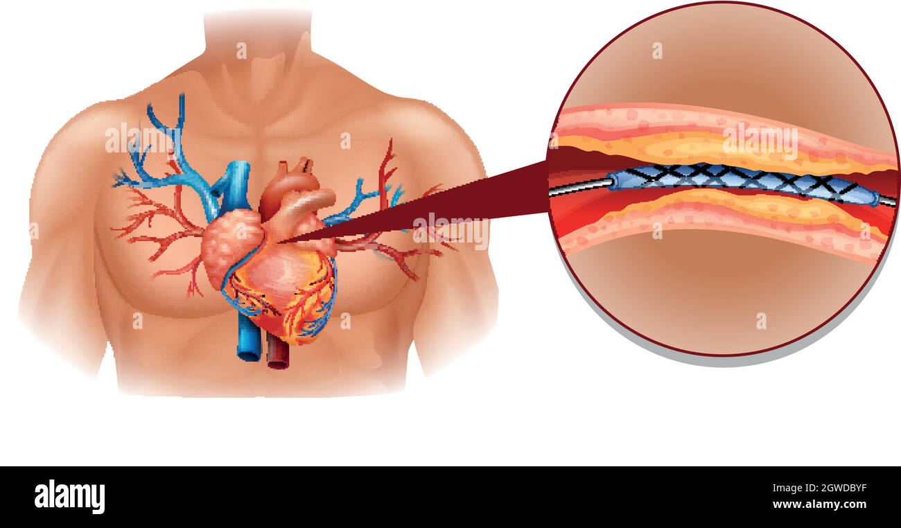 Human heart diagram with balloon tube Stock Vector
