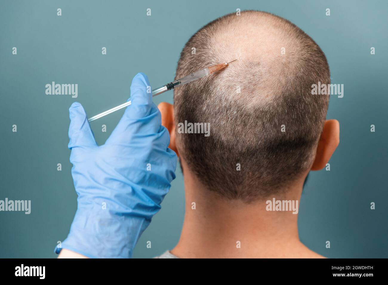 Mesotherapy. The trichologist doctor's hand makes an injection into the lesion of baldness. Back view. Turquoise background. The concept of aesthetic Stock Photo