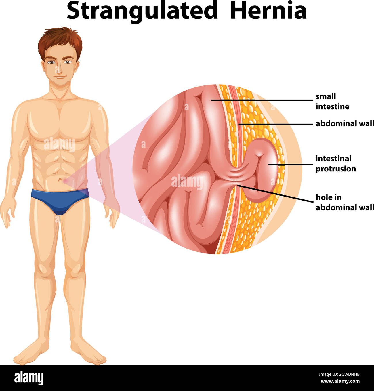 Human Anatomy of Strangulated Hernia Stock Vector