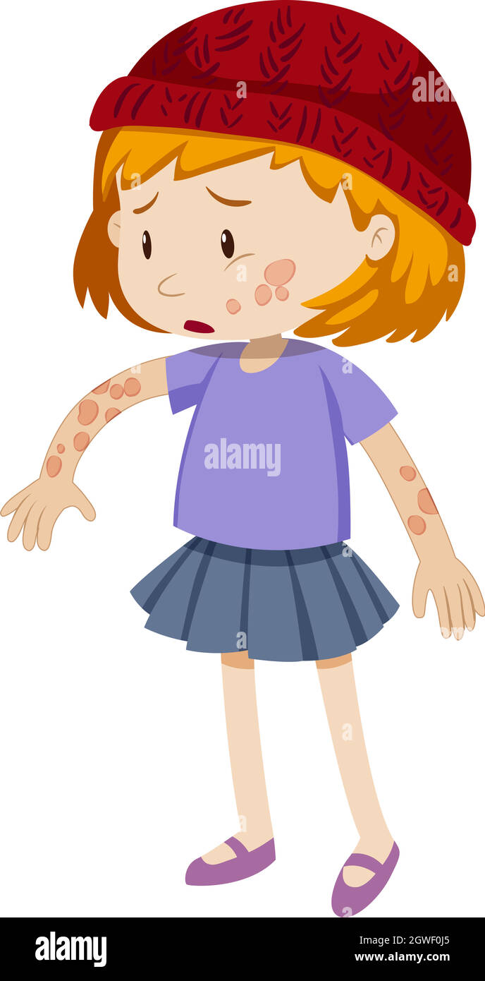 Little girl with ringworm on her body Stock Vector