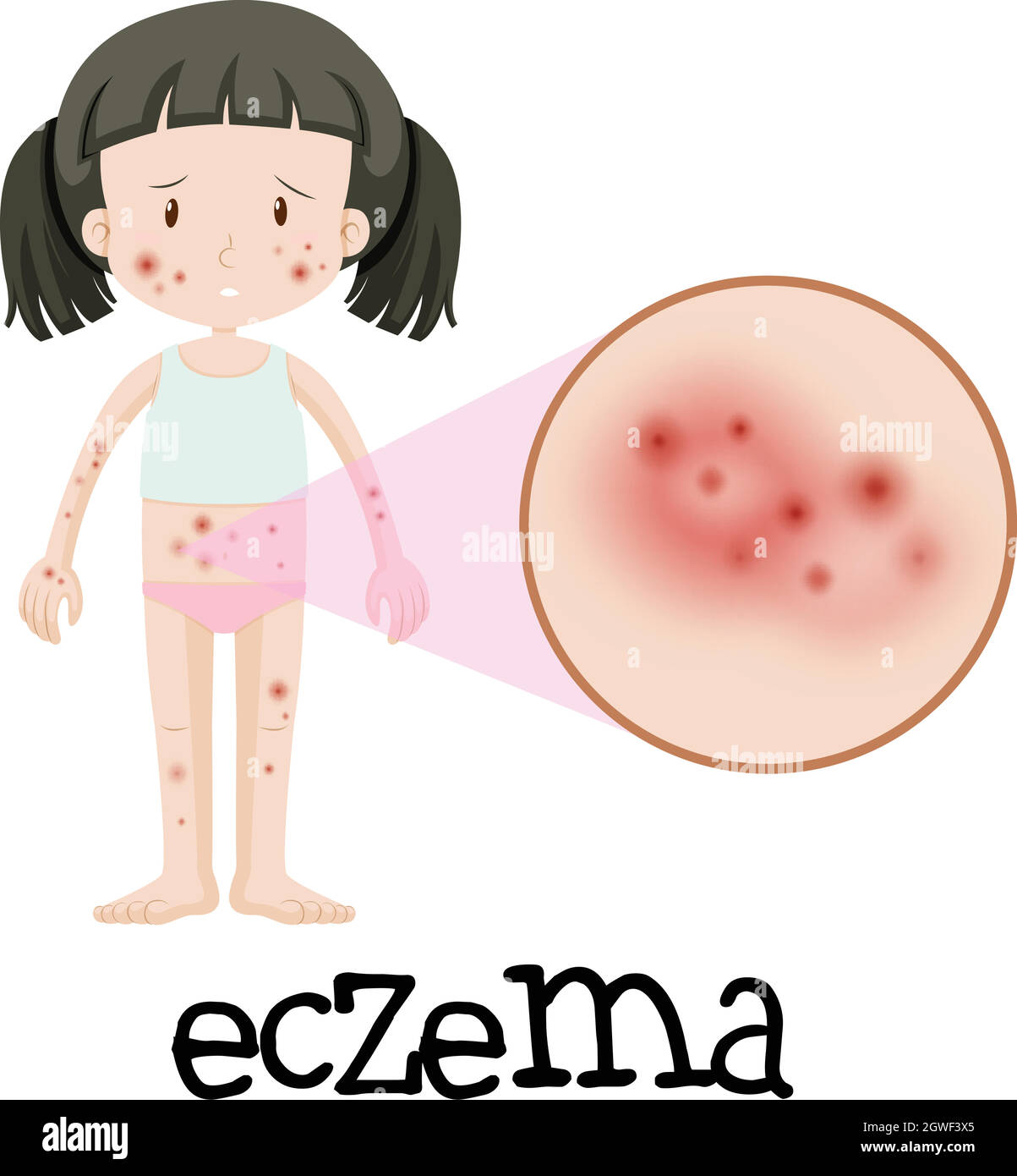 A Girl with Eczema on White Background Stock Vector Image & Art - Alamy