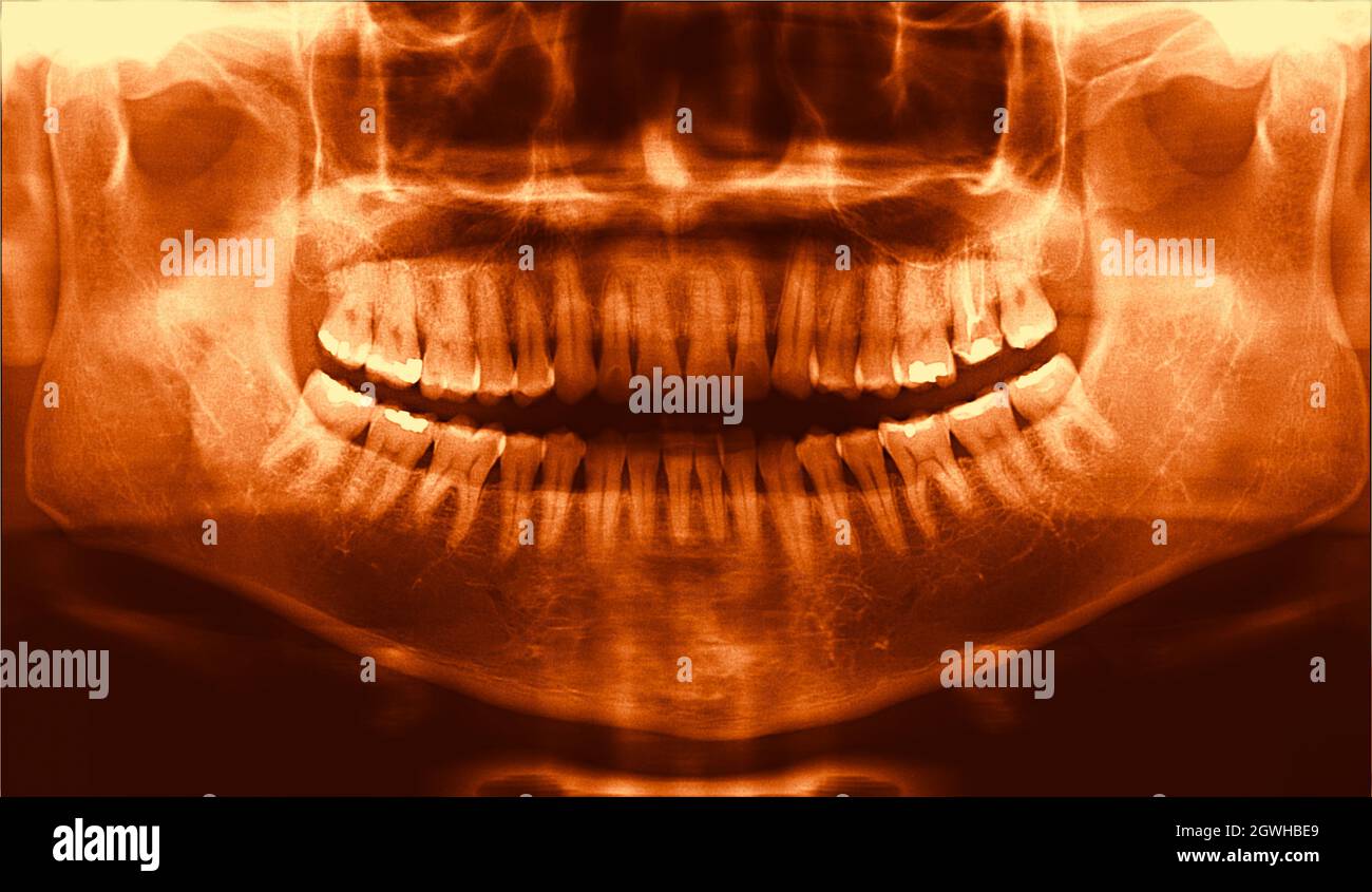 full arch wide maxillary male dental panoramic XRay radiography Stock Photo Alamy