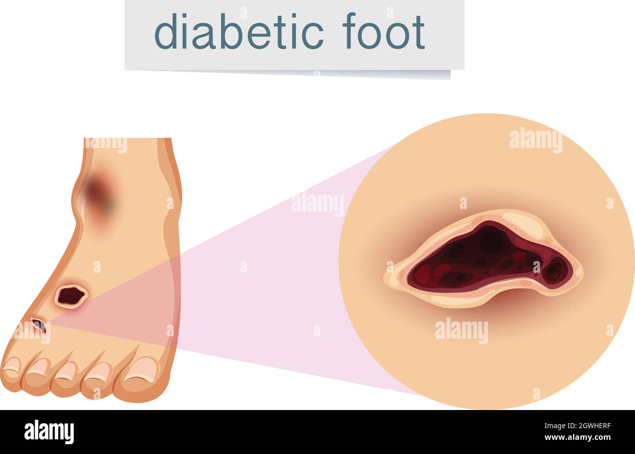 A human foot with diabetic Stock Vector