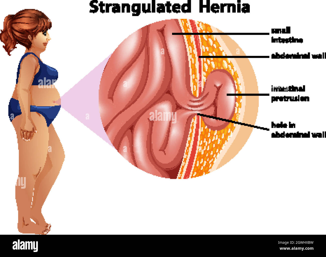 Strangulated Hernia information infographic Stock Vector