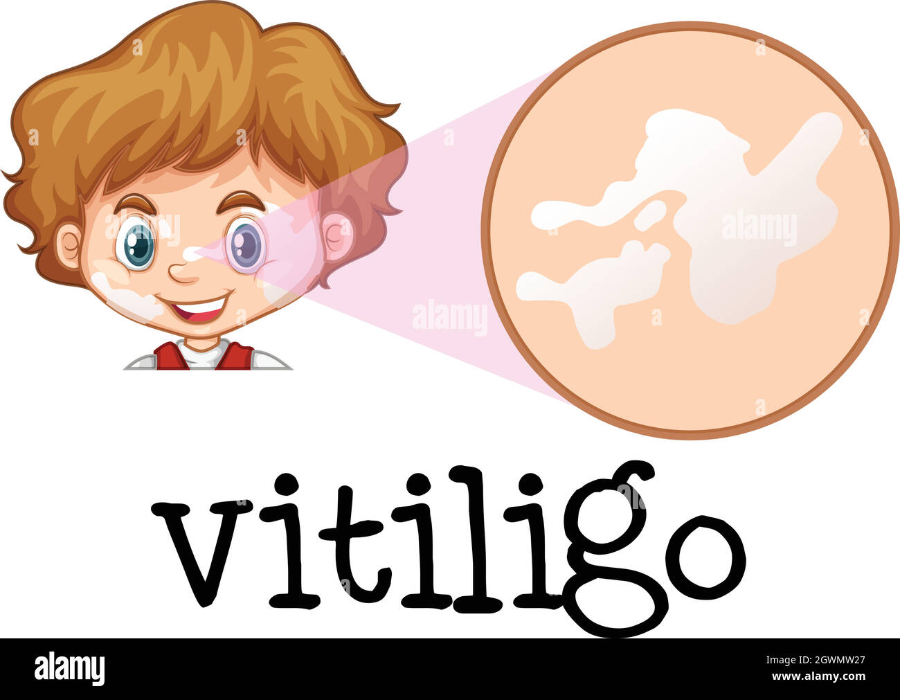 A Boy with Vitiligo on Face Stock Vector