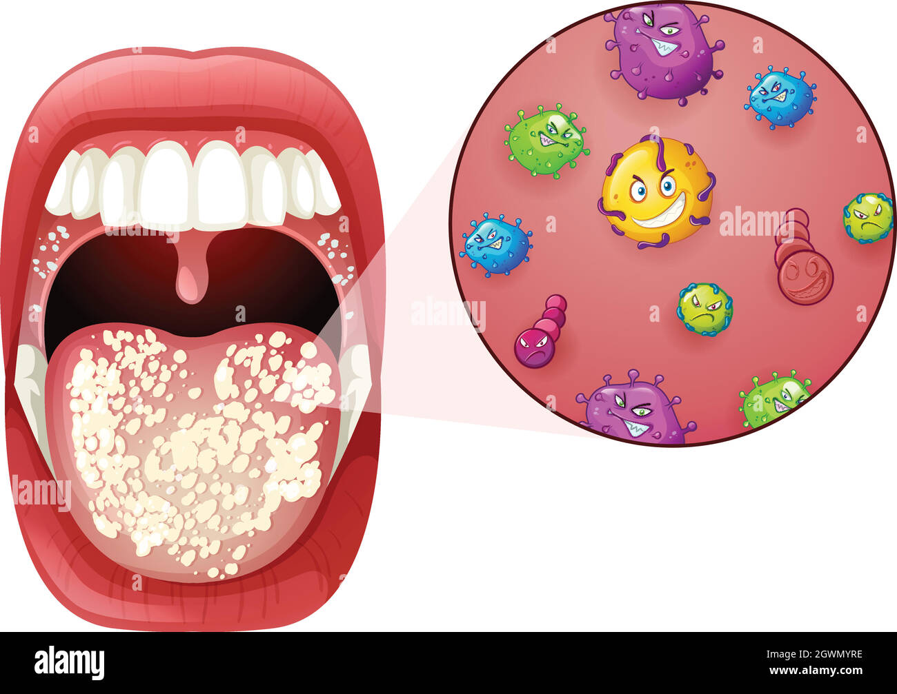 A Human Mouth Virus Infection Stock Vector