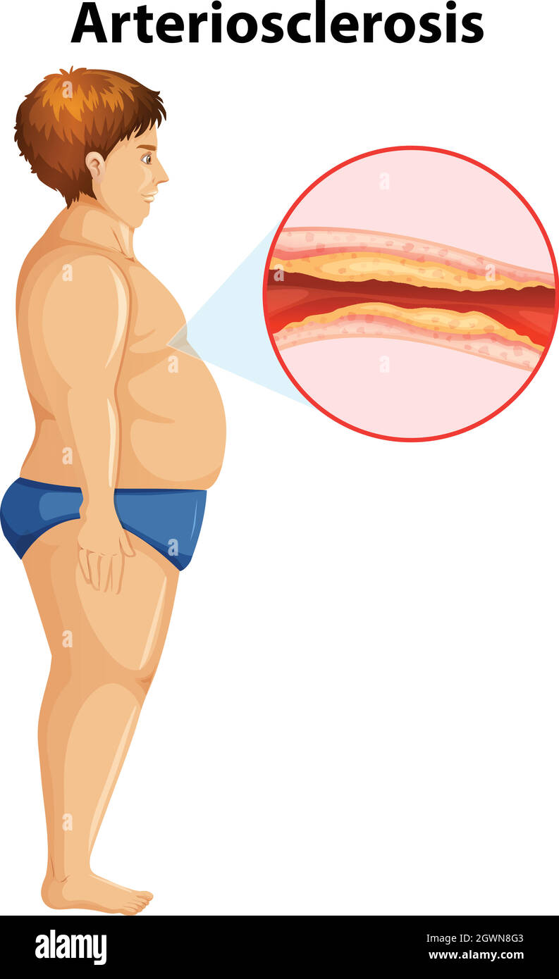 An Overweight Man with Arteriosclerosis Stock Vector