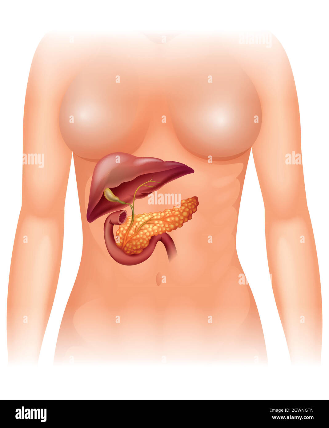 Pancreas cancer in human Stock Vector