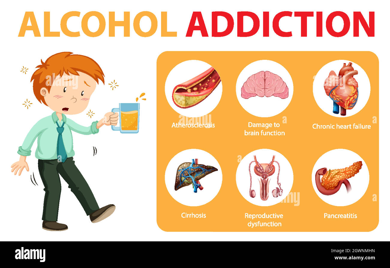 Alcohol addiction or alcoholism information infographic Stock Vector