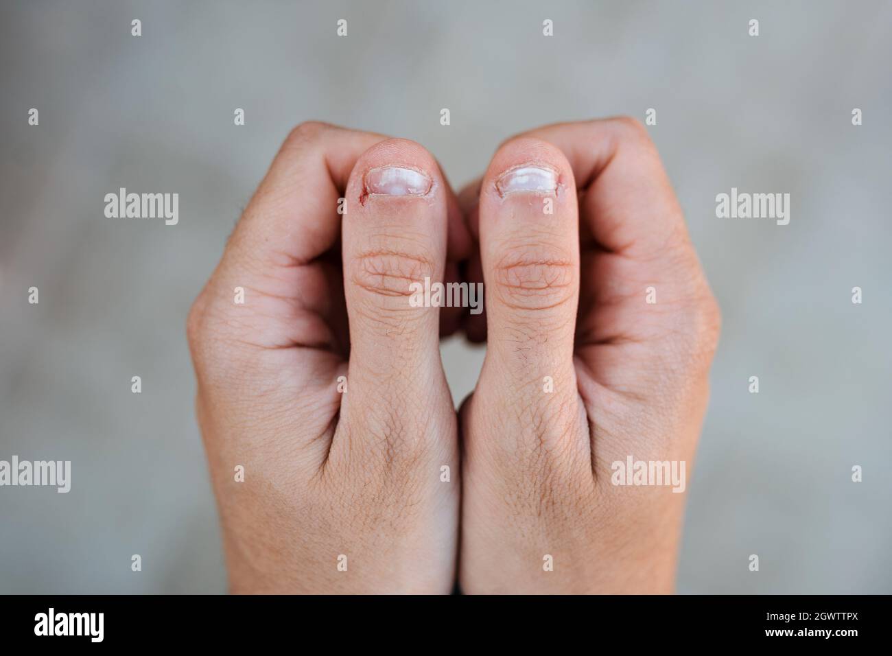 Cuticle wound hires stock photography and images Alamy
