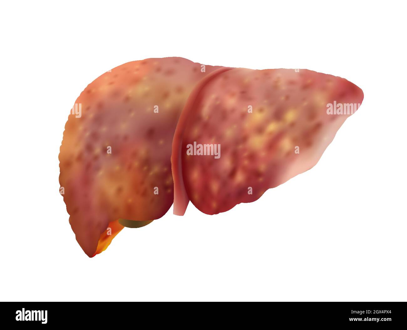 Realistic vector illustration of cirrhosis of human liver isolated on white Stock Vector