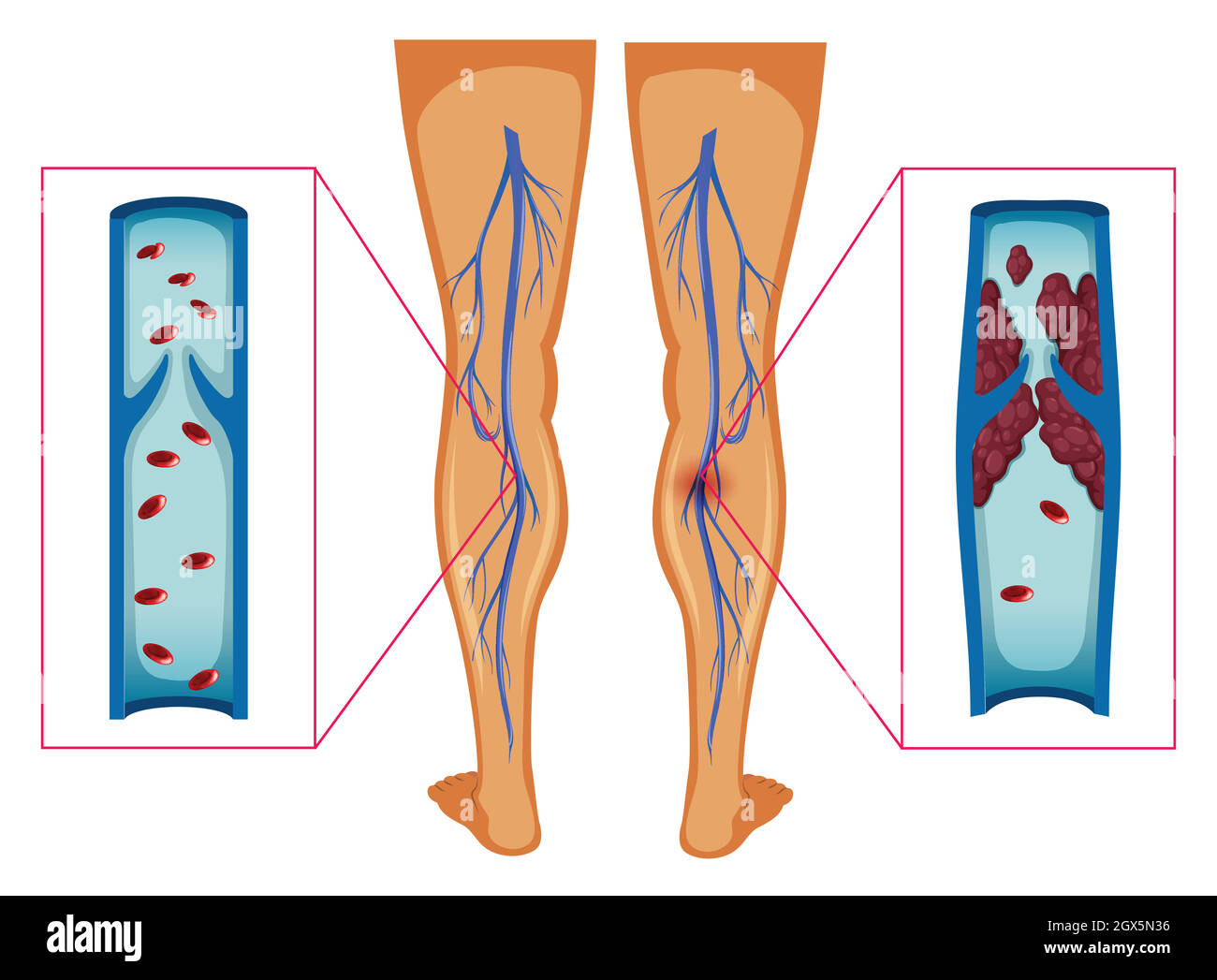 Diagram showing blood clot in human legs Stock Vector