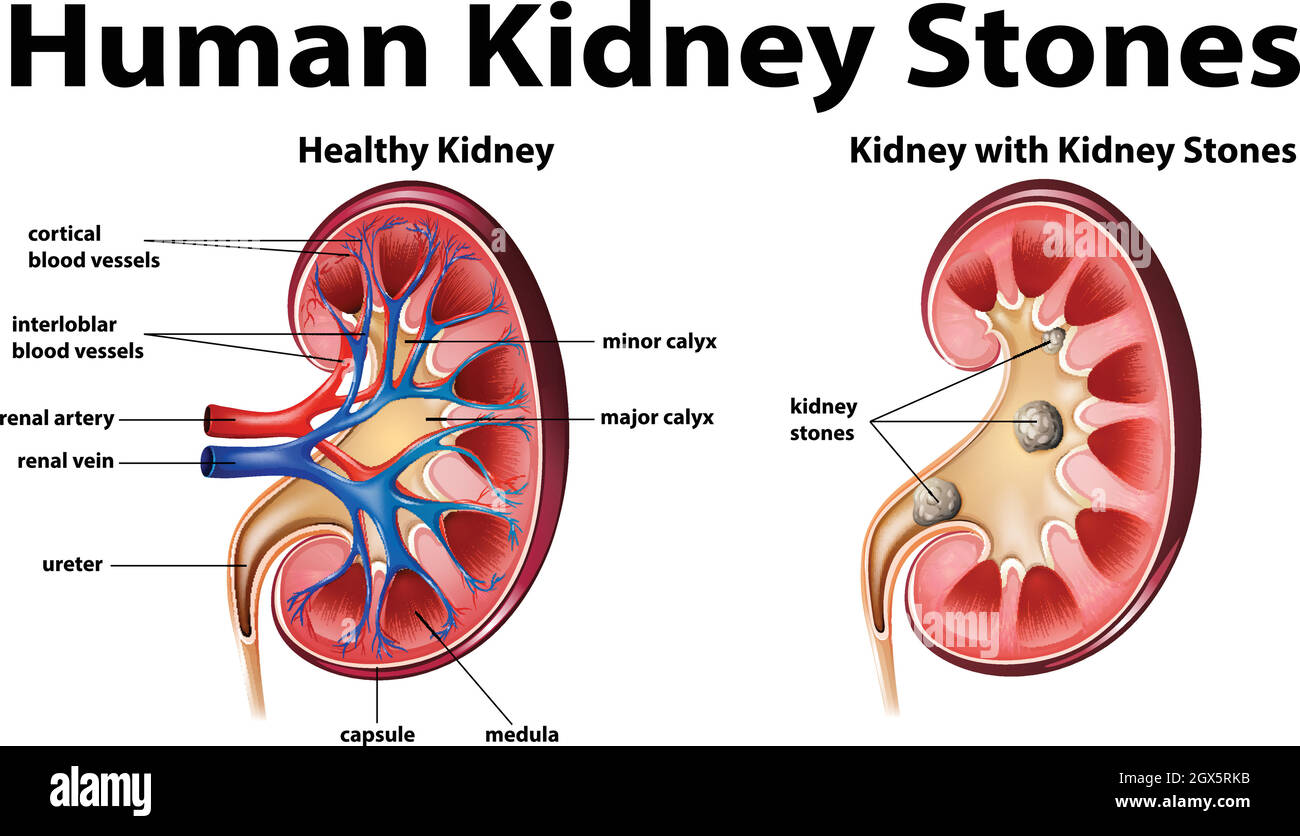 Human anatomy diagram with kidney stones Stock Vector