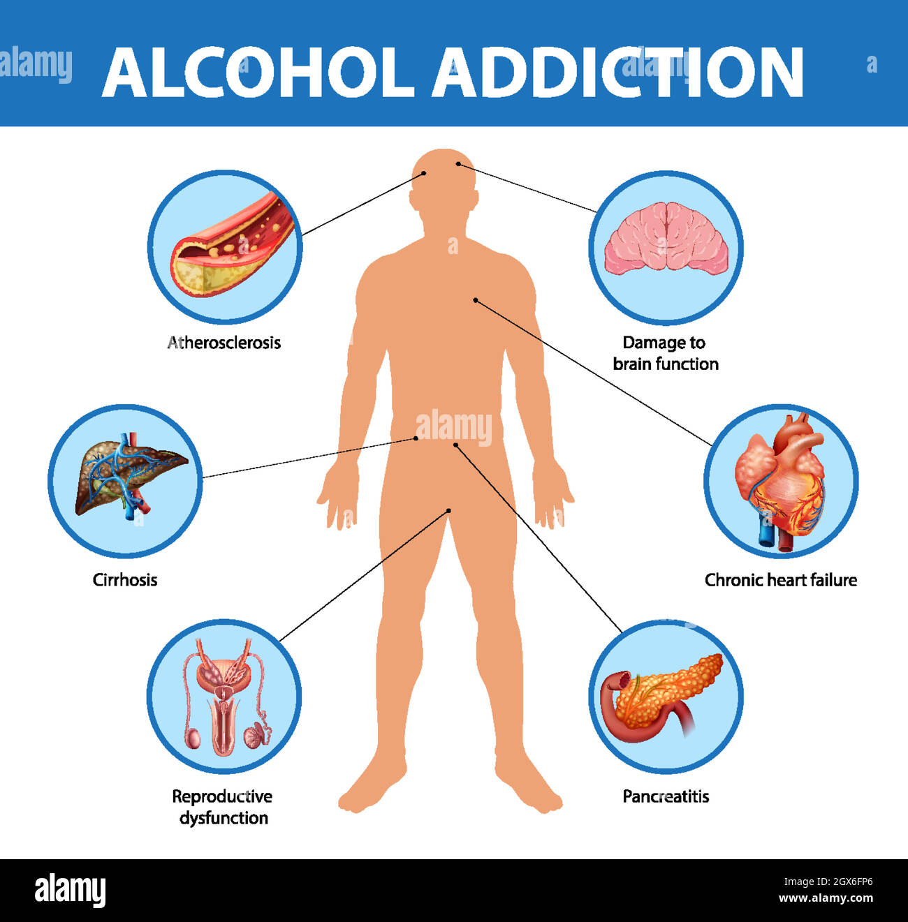 Alcohol addiction or alcoholism information infographic Stock Vector