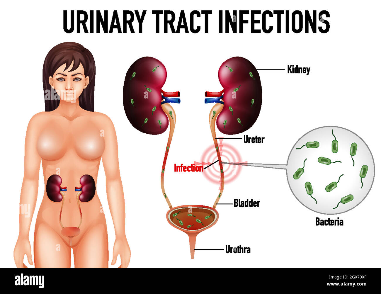 Information poster of urinary tract infections Stock Vector