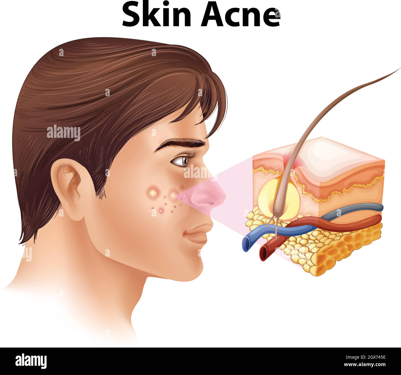 A Young Man with Acne Problem Stock Vector