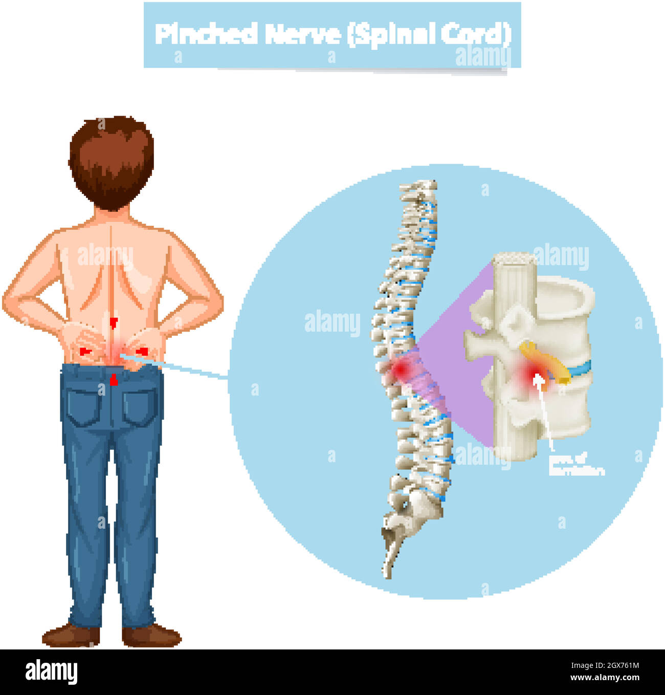 Diagram showing man and pinched nerve Stock Vector Image & Art - Alamy